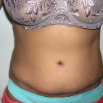 Tummy Tuck Before & After Patient #3666