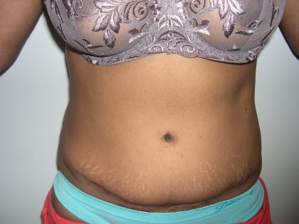 Tummy Tuck Before & After Patient #3666