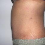 Tummy Tuck Before & After Patient #3666