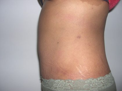 Tummy Tuck Before & After Patient #3666