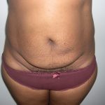 Tummy Tuck Before & After Patient #3666