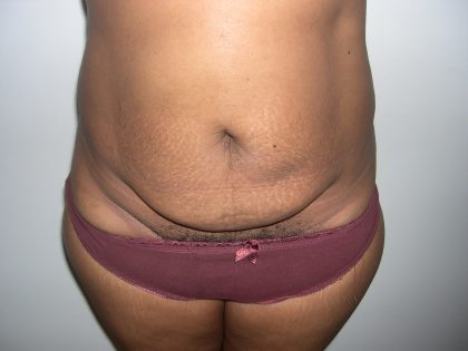 Tummy Tuck Before & After Patient #3666