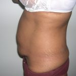 Tummy Tuck Before & After Patient #3666