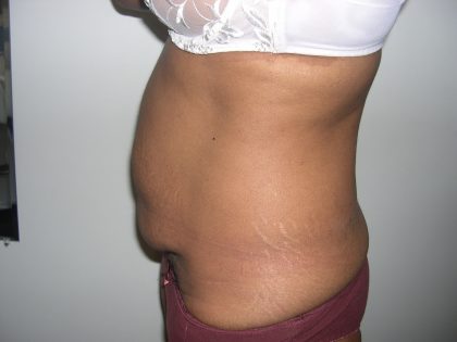 Tummy Tuck Before & After Patient #3666
