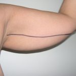 Liposuction Before & After Patient #3814