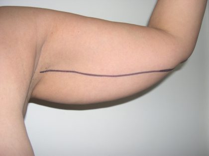 Liposuction Before & After Patient #3814