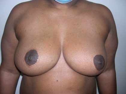 Breast Reduction Before & After Patient #3755