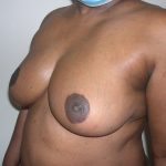 Breast Reduction Before & After Patient #3755