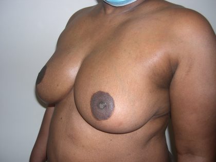 Breast Reduction Before & After Patient #3755