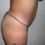 Buttock Augmentation Before & After Patient #3779