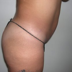 Buttock Augmentation Before & After Patient #3779