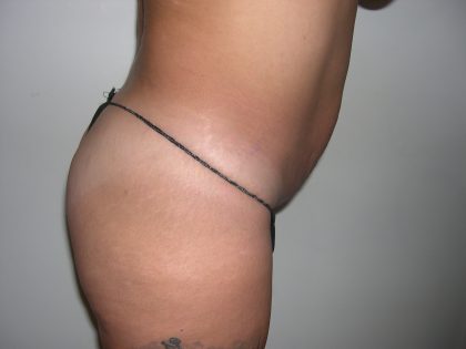 Buttock Augmentation Before & After Patient #3779