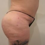 Buttock Augmentation Before & After Patient #3779