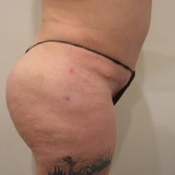 Buttock Augmentation Before & After Patient #3779