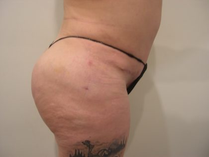 Buttock Augmentation Before & After Patient #3779