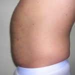 Liposuction Male Before & After Patient #3894
