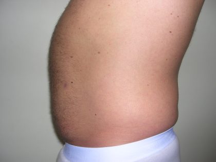 Liposuction Male Before & After Patient #3894