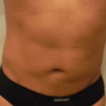 Liposuction Male Before & After Patient #3894