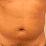 Liposuction Male Before & After Patient #3894