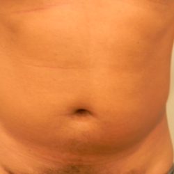 Liposuction Male Before & After Patient #3894