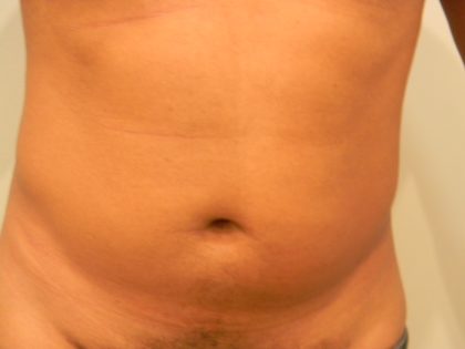 Liposuction Male Before & After Patient #3894