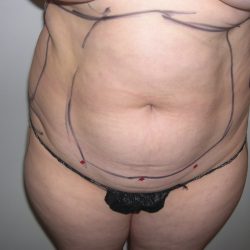 Liposuction Before & After Patient #3817