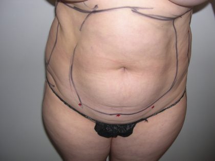 Liposuction Before & After Patient #3817