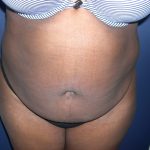 Tummy Tuck Before & After Patient #3667