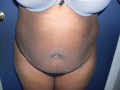Tummy Tuck Before & After Patient #3667