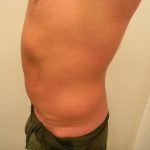 Liposuction Male Before & After Patient #3894