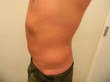 Liposuction Male Before & After Patient #3894