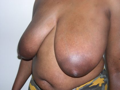 Breast Reduction Before & After Patient #3760