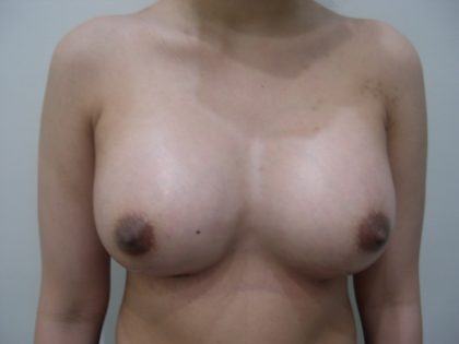 Breast Augmentation Before & After Patient #3695