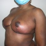 Breast Reduction Before & After Patient #3760