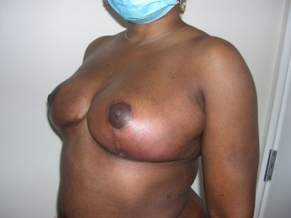 Breast Reduction Before & After Patient #3760