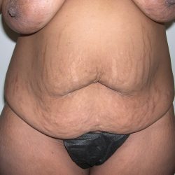 Tummy Tuck Before & After Patient #4052
