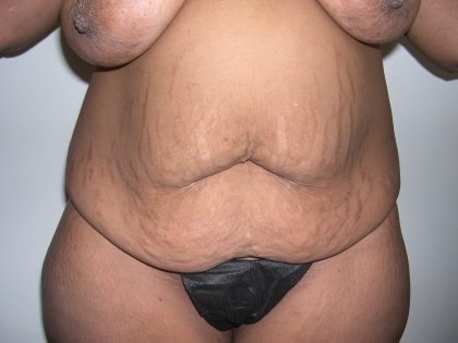 Tummy Tuck Before & After Patient #4052