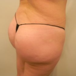 Buttock Augmentation Before & After Patient #3782
