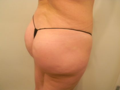 Buttock Augmentation Before & After Patient #3782