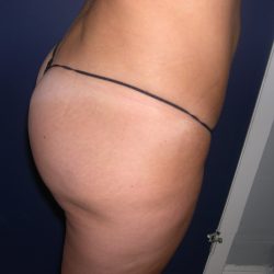 Buttock Augmentation Before & After Patient #3782