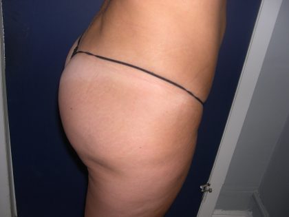 Buttock Augmentation Before & After Patient #3782