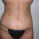 Liposuction Before & After Patient #3820
