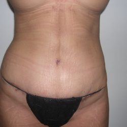 Liposuction Before & After Patient #3820
