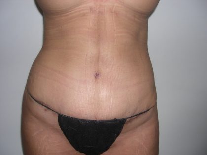 Liposuction Before & After Patient #3820