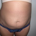 Liposuction Before & After Patient #3820