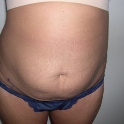 Liposuction Before & After Patient #3820