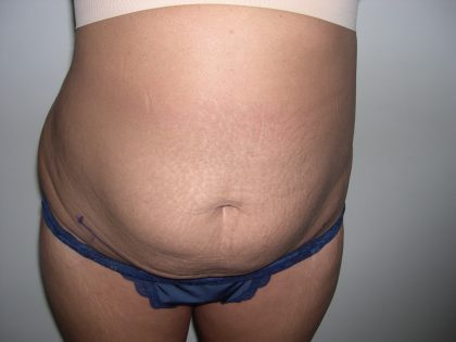 Liposuction Before & After Patient #3820