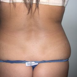 Liposuction Before & After Patient #3823