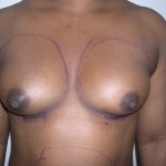 Breast Augmentation Before & After Patient #3711
