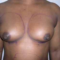 Breast Augmentation Before & After Patient #3711